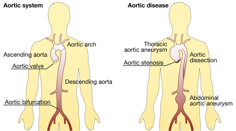 Aortic disease