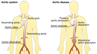 Aortic disease