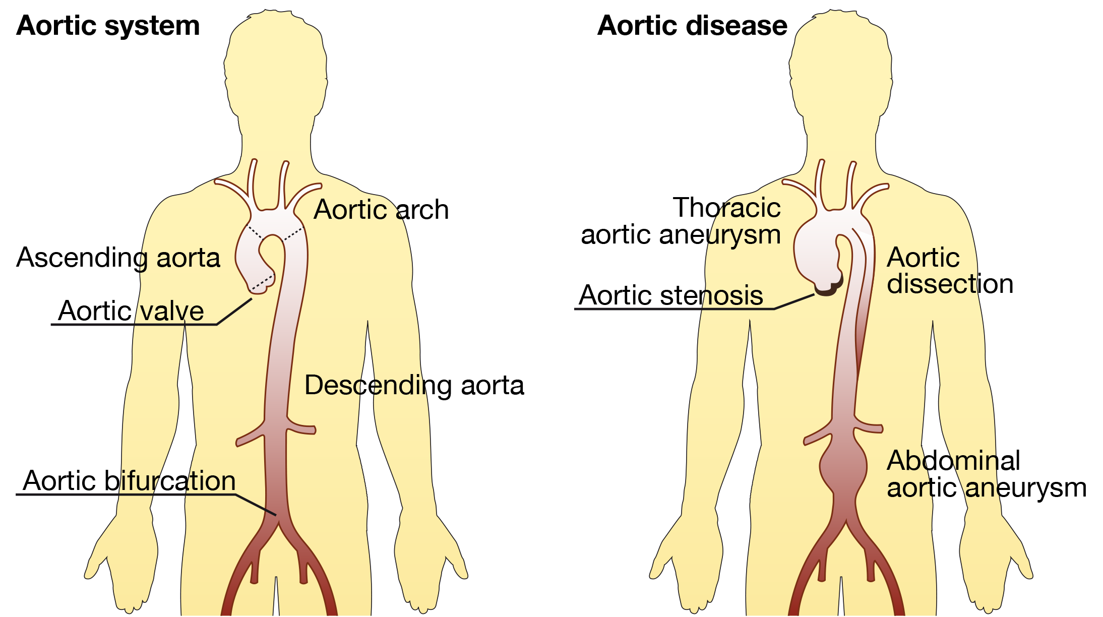 Aortic disease