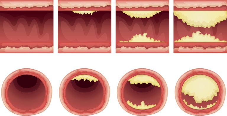 Artherosclerosis_COLOURBOX8814937_cb_ID8814937.jpg