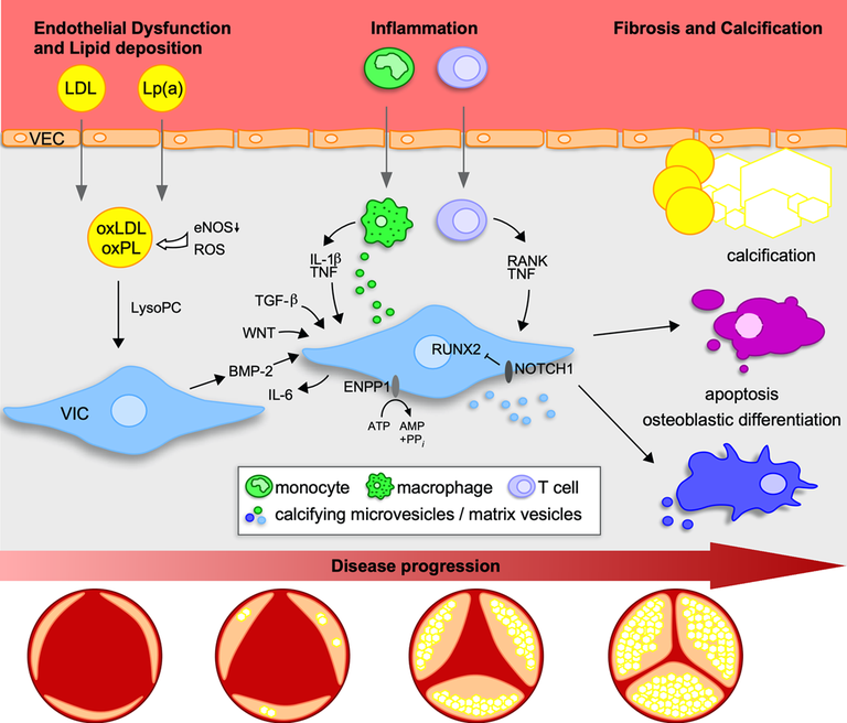 Phases of calcific aortic valve disease -CAVD.png